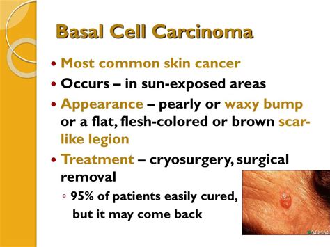 Ppt Integumentary System Part 2 Skin Disorders Powerpoint