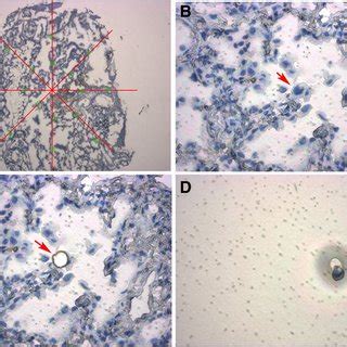 Single Tumor Cell Isolation By Laser Capture Microdissection Lcm A