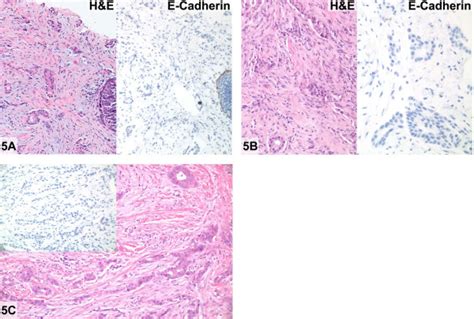 Invasive Lobular Carcinoma With Glandular Ductal Differentiation