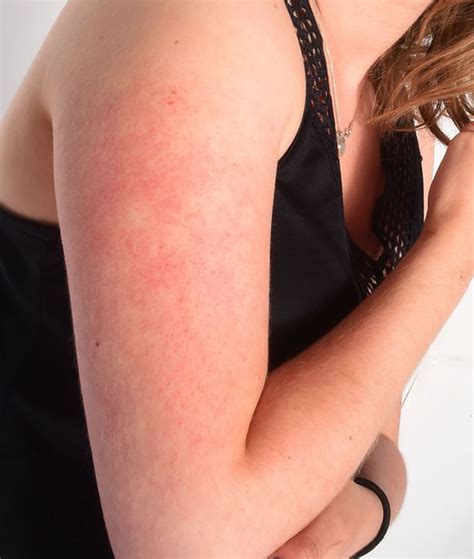 How To Get Rid Of Those Annoying Red Bumps On Your Arms