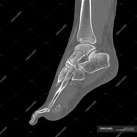 Fractured ankle bone, computer illustration — bones, foot - Stock Photo