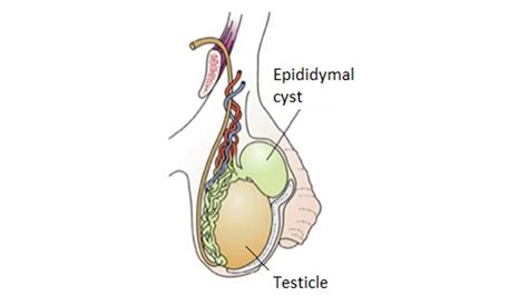 Excision Of Epididymal Cyst Spencer Murray Urology