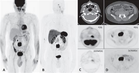 Maximum Intensity Projection Mip Of The Fdg Pet Ct A