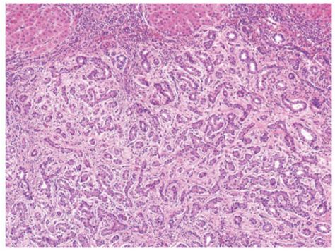 Benign And Malignant Biliary Tumors Basicmedical Key