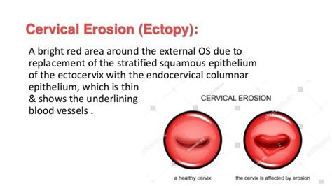 Cervical Ectropion Cervix