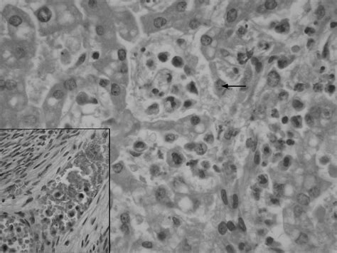 Malignant Histiocytosis A Case Report Of A Rare Tumour Presenting With