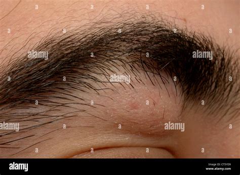 Benign Tumor Hi Res Stock Photography And Images Alamy