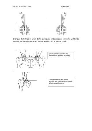 Cálculo del ángulo acetabular PDF