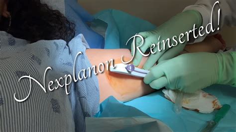 Nexplanon Insertion Birth Control Reinserted Risi Newton Youtube