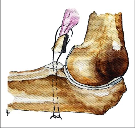 -The "lasso technique" for coronoid fracture fixation. | Download Scientific Diagram