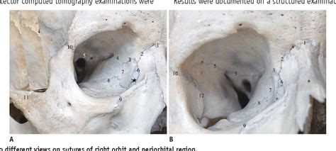 Structure of temporozygomatic suture of skull | Semantic Scholar