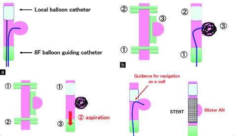 Pictorial Diagram A Showing Balloon Dilatation Proximal And Distal To