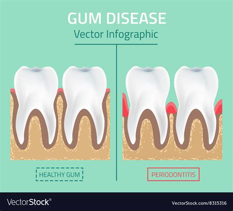 Teeth Infographic Gum Disease Stages Royalty Free Vector