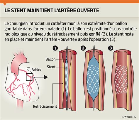 Infographie médicale Stent cardiaque Le Matin 2013 on Behance