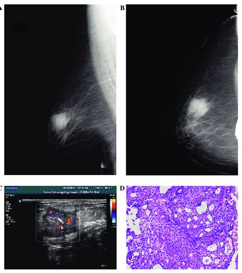 Case 5 From Table I A Oblique And B Axial Mammography Findings A