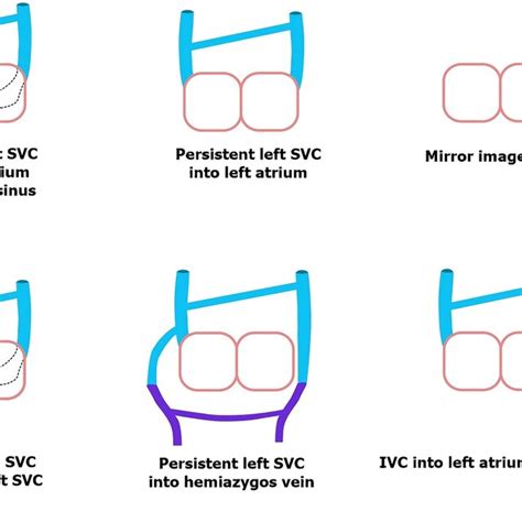 The Illustration Shows A Persistent Left Superior Vena Cava Svc And Download Scientific