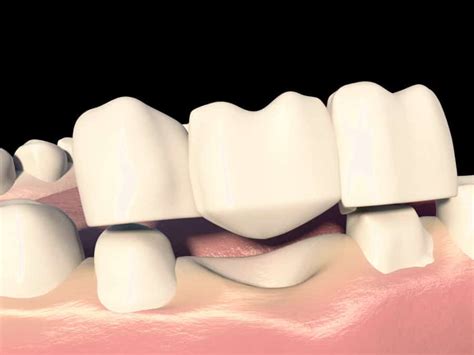 Zahnbr Cke Optionen F R Den Zahnersatz Smile Poliklinik