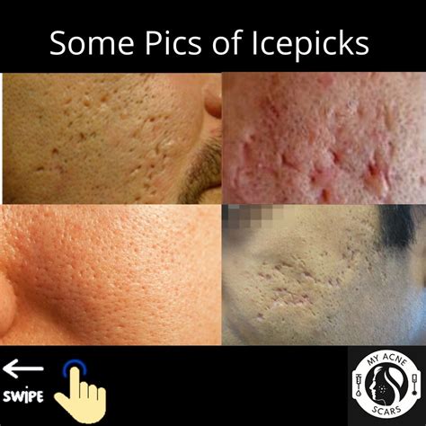 Icepick Acne Scars - A Overview - My Acne Scars