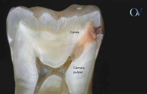 ᐈ Pulpitis reversible pulpitis irreversible y necrosis pulpar