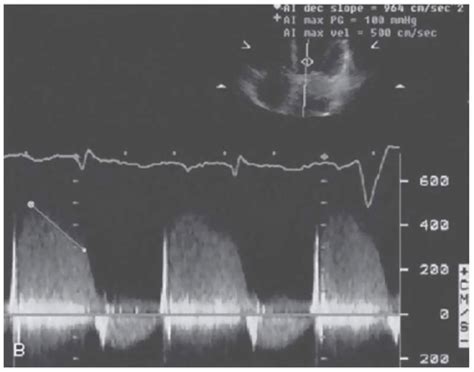 Endocarditis And Other Pathologic And Normal Anatomic Variants Thoracic Key