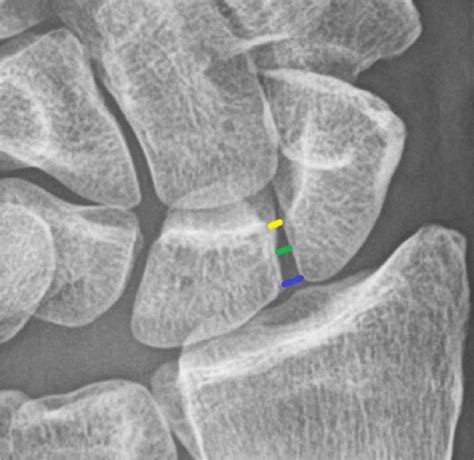 The Optimal Location To Measure Scapholunate Diastasis On Screening