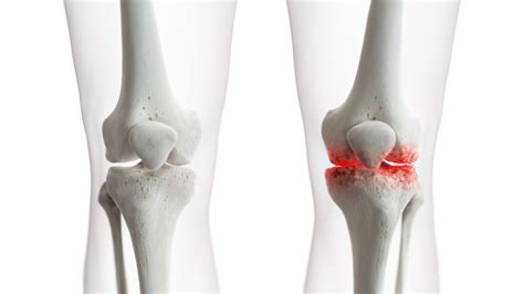 Knee Osteoarthritis Clinical Trial - Ohio State MD Connect