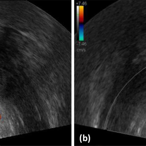 Ultrasound Doppler Validation Of Our Technology 3d Nvb In Trus After