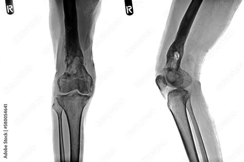 Knee Osteoarthritis. Film x-ray of osteoarthritis knee patient and ...