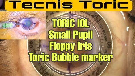 157 Toric IOL In A Small Pupil Toric Bubble Marker Axis Marking