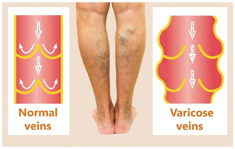 Advantages Of A Phlebectomy For Treating Varicose Veins Vein Laser