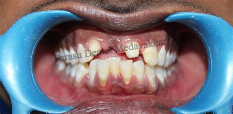 Basal Dental Implants In Chennai Permanent Tooth In 3 Days In Chennai