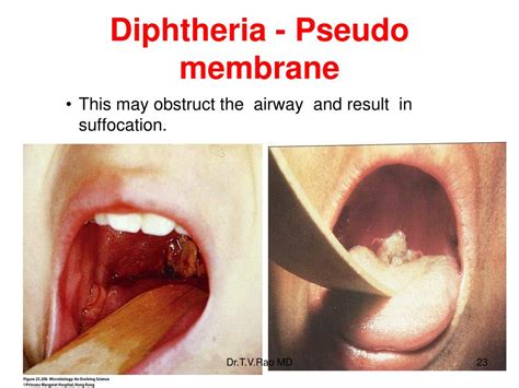 PPT - Diphtheria Corynebacterium diphtheria Kleb’s – Loffler's bacilli ...