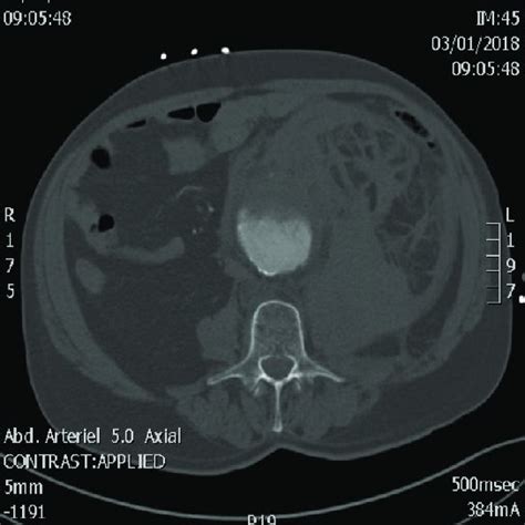 Traitement Endovasculaire D Un An Vrisme De L Aorte Abdominale