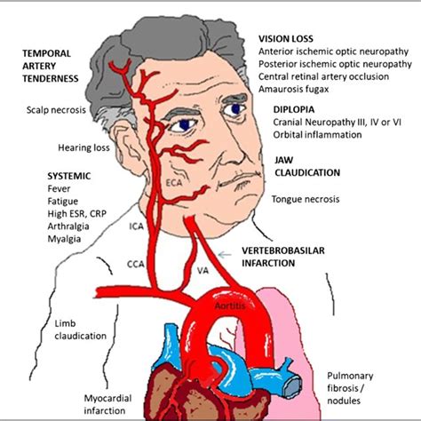 Pathogenesis Of Giant Cell Arteritis Unknown Environmental Stimuli