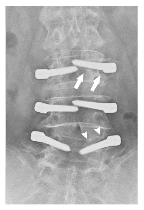 Anteroposterior Radiographs A A Year Old Female Who Underwent