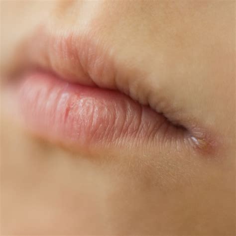 Angular Cheilitis Symptoms And Treatment Travocure