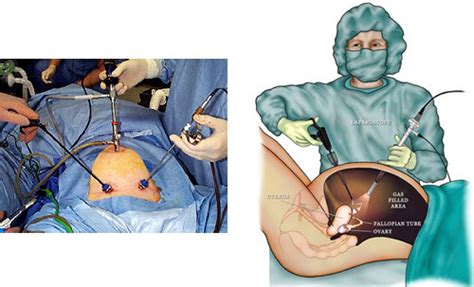 Ovarian Cyst Tanda Dan Cara Merawatnya