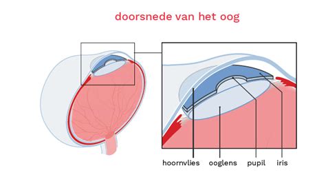 Wat Is Staar Cataract Behandelingstraject Bergman Clinics