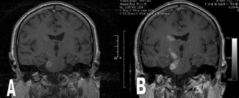 Rm Corte Coronal En Secuencia T Con Gadolinio A Imagen Inicial B