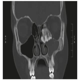 E Intraoperative Endoscopic Spitting Images Illustrate Various Nasal