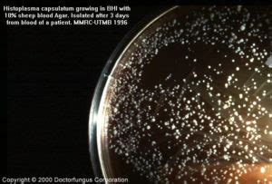 Histoplasmosis Due To Histoplasma Capsulatum Doctor Fungus