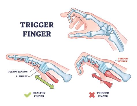 Trigger Finger Treatment - Prescott, AZ | Restored Hope