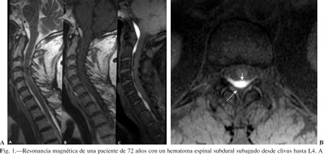 Spinal Subdural Hematoma