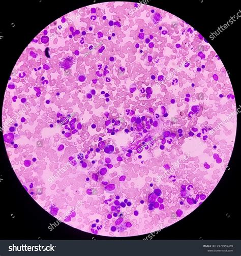 Microscopic View Bone Marrow Slide Acute Stock Photo