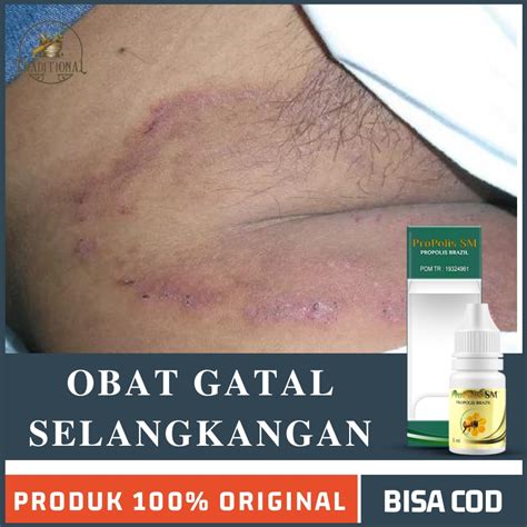 Jamur Selangkangan Obat Homecare24