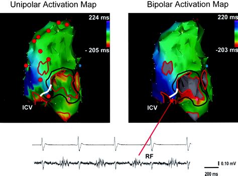 Voltage And Activation Mapping Circulation