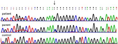 Sanger Sequencing Validation Of The N K Variant Sanger Sequencing Of