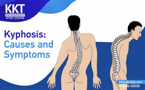 Kyphosis Treatment: Causes and symptoms