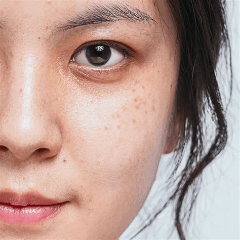 Pigmentation Dr Wang Yi Shi W Skin And Laser Clinic