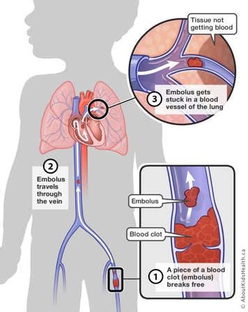 Deep vein thrombosis (DVT)